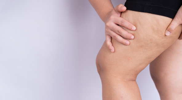 Cellulitis